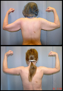 Brachioplasty before and after pictures.