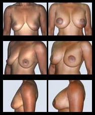 Breast Lift before and after pictures.