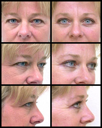 Eyelid lift surgery before and after pictures.