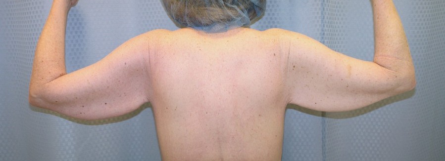 brachioplasty-arm-lift-sagging-arm-skin-claremont-upland-woman-before-back-dr-maan-kattash