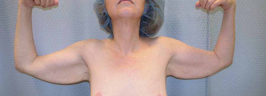 brachioplasty-arm-lift-sagging-arm-skin-claremont-upland-woman-before-front-dr-maan-kattash