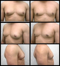 Male Breast Reduction before and after pictures.