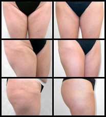 Liposuction before and after pictures.