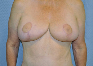 breast-lift-plastic-surgery-irvine-upland-woman-after-front-dr-maan-kattash