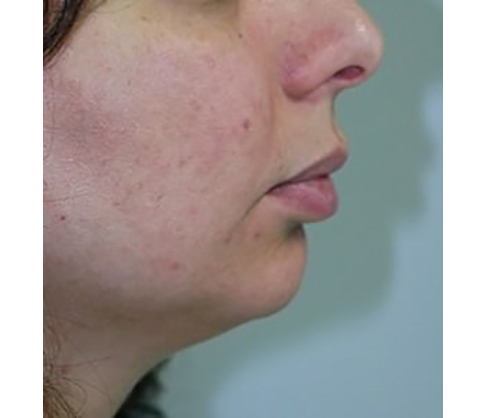chin-augmentation-cheek-plastic-surgery-los-angeles-woman-before-side-dr-maan-kattash