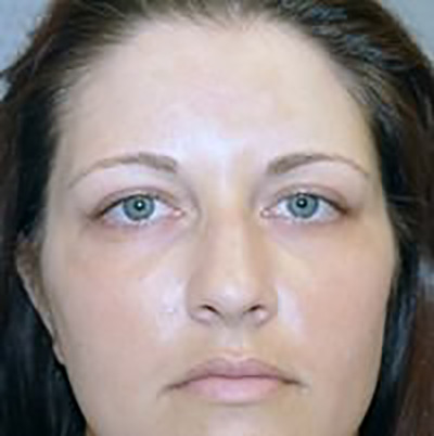 eyelid-lift-blepharoplasty-plastic-surgery-los-angeles-woman-before-front-dr-maan-kattash