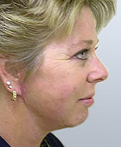 facelift-cosmetic-surgery-beverly-hills-woman-after-side-dr-maan-kattash