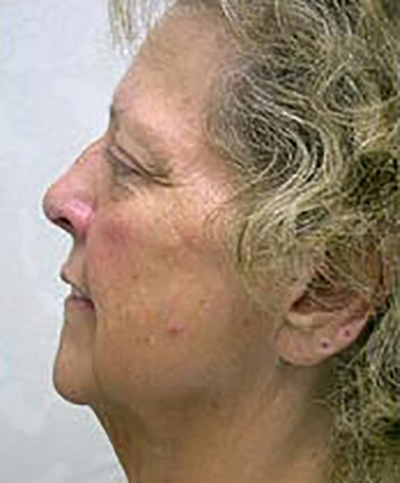 facelift-plastic-surgery-rancho-cucamonga-woman-before-side-dr-maan-kattash