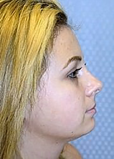rhinoplasty-plastic-surgery-nose-job-upland-woman-after-side-dr-maan-kattash2