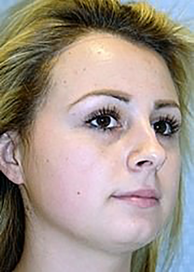 rhinoplasty-plastic-surgery-nose-job-upland-woman-before-oblique-dr-maan-kattash