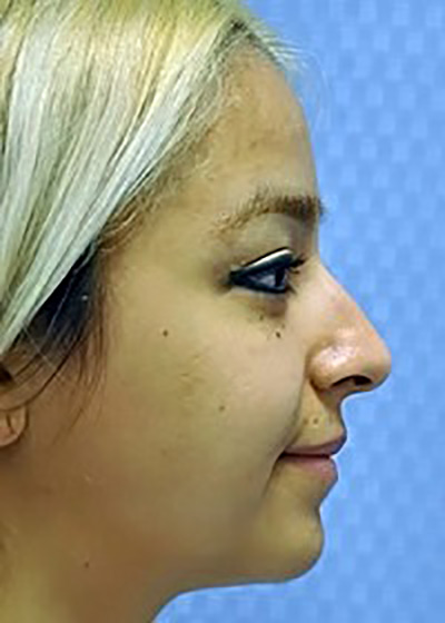 rhinoplasty-surgery-nose-job-claremont-before-side-dr-maan-kattash2