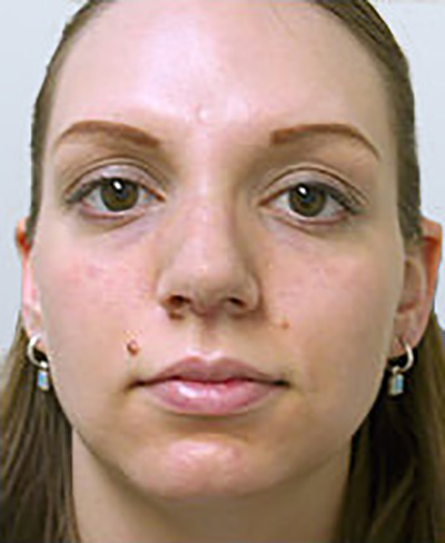 rhinoplasty-surgery-nose-job-los-angeles-woman-after-front-dr-maan-kattash2