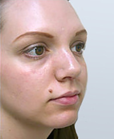 rhinoplasty-surgery-nose-job-los-angeles-woman-after-oblique-dr-maan-kattash2