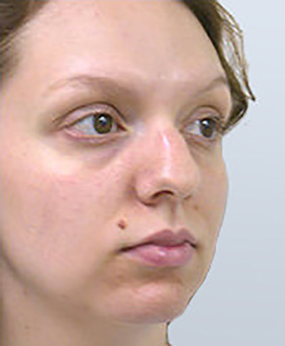 rhinoplasty-surgery-nose-job-los-angeles-woman-before-oblique-dr-maan-kattash2