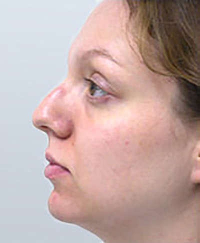 rhinoplasty-surgery-nose-job-los-angeles-woman-before-side-dr-maan-kattash2