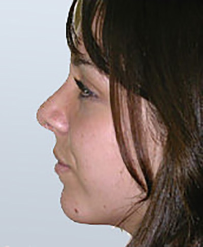 rhinoplasty-surgery-nose-job-los-rancho-cucamonga-after-side-dr-maan-kattash2