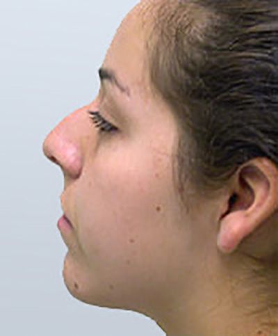 rhinoplasty-surgery-nose-job-los-rancho-cucamonga-before-side-dr-maan-kattash2