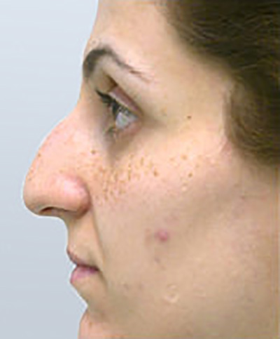 rhinoplasty-surgery-nose-job-tustin-woman-before-side-dr-maan-kattash2