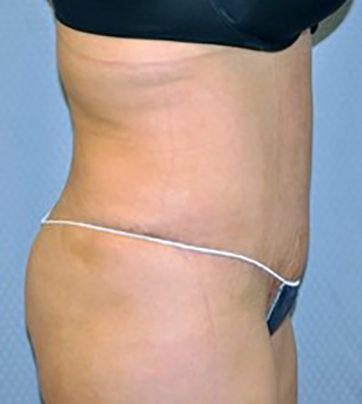 tummy-tuck-cosmetic-surgery-abdominoplasty-rancho-cucamonga-woman-after-side-dr-maan-kattash