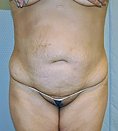 tummy-tuck-cosmetic-surgery-abdominoplasty-rancho-cucamonga-woman-before-front-dr-maan-kattash