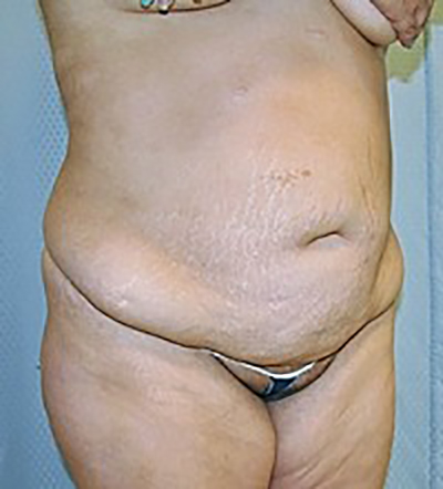 tummy-tuck-cosmetic-surgery-abdominoplasty-rancho-cucamonga-woman-before-oblique-dr-maan-kattash
