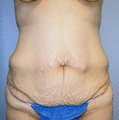 tummy-tuck-plastic-surgery-abdominoplasty-loose-skin-ontario-woman-before-front-dr-maan-kattash