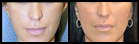 Dermal Fillers before and after pictures.