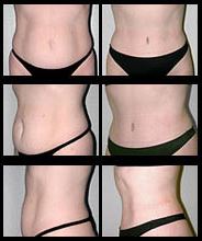 Tummy Tuck before and after pictures.