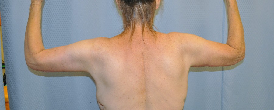 brachioplasty-arm-lift-sagging-arm-skin-beverly-hills-woman-after-back-dr-maan-kattash