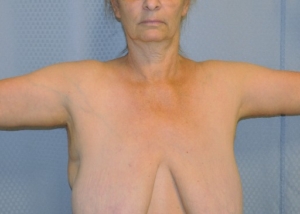 brachioplasty-arm-lift-sagging-arm-skin-beverly-hills-woman-after-front-dr-maan-kattash