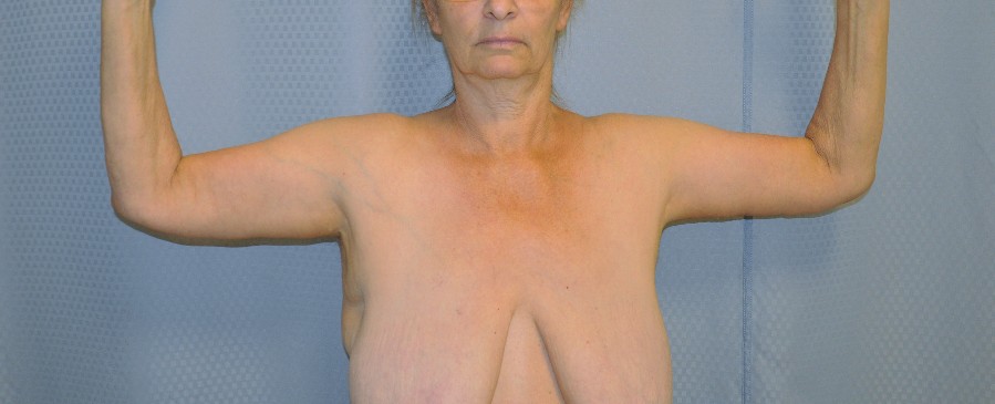 brachioplasty-arm-lift-sagging-arm-skin-beverly-hills-woman-after-front-dr-maan-kattash