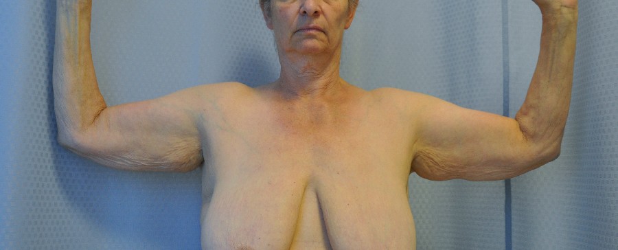 brachioplasty-arm-lift-sagging-arm-skin-beverly-hills-woman-before-front-dr-maan-kattash