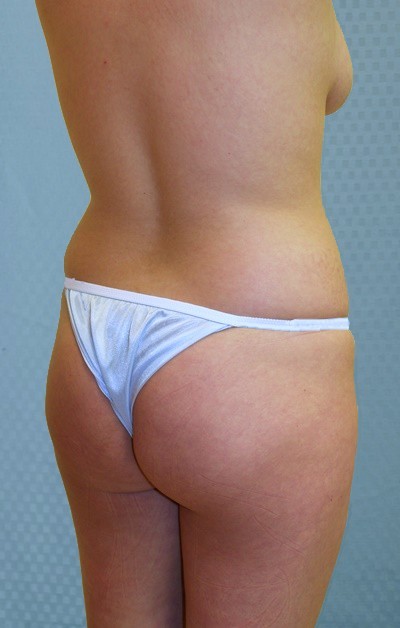brazilian-butt-lift-augmentation-plastic-surgery-upland-victorville-woman-before-back-dr-maan-kattash