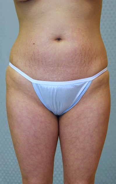 brazilian-butt-lift-augmentation-plastic-surgery-upland-victorville-woman-before-front-dr-maan-kattash