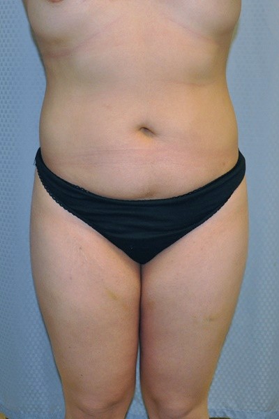 brazilian-butt-lift-cosmetic-surgery-beverly-hills-woman-before-front-dr-maan-kattash