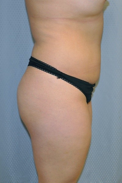 brazilian-butt-lift-cosmetic-surgery-beverly-hills-woman-before-side-dr-maan-kattash