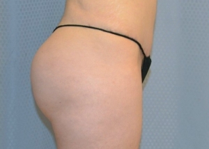 brazilian-butt-lift-cosmetic-surgery-redlands-woman-after-side-dr-maan-kattash