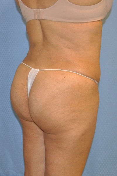 brazilian-butt-lift-plastic-cosmetic-surgery-inland-empire-woman-after-back-dr-maan-kattash