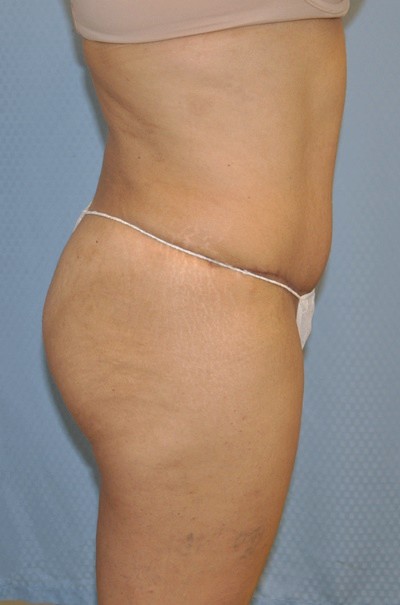 brazilian-butt-lift-plastic-cosmetic-surgery-inland-empire-woman-after-side-dr-maan-kattash