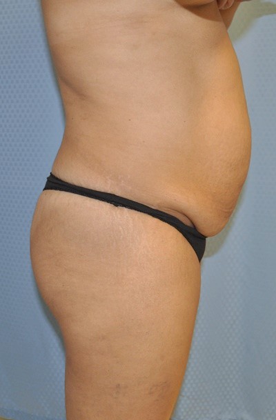 brazilian-butt-lift-plastic-cosmetic-surgery-inland-empire-woman-before-side-dr-maan-kattash