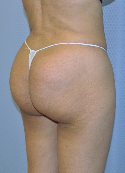 brazilian-butt-lift-plastic-surgery-beverly-hills-los-angeles-woman-after-back-dr-maan-kattash