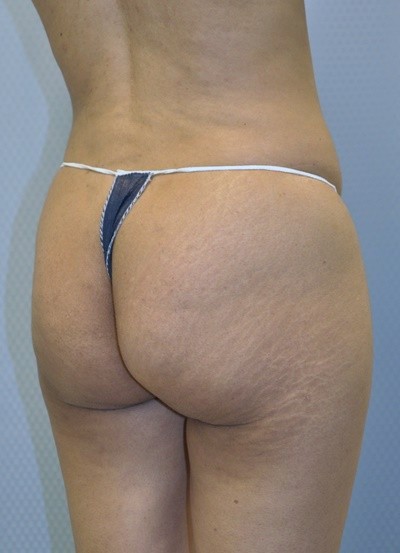 brazilian-butt-lift-plastic-surgery-beverly-hills-los-angeles-woman-before-back-dr-maan-kattash