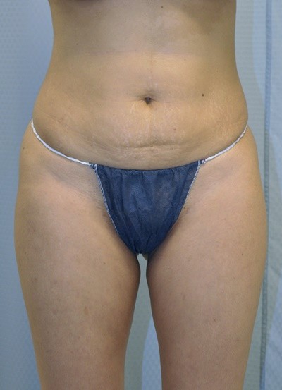 brazilian-butt-lift-plastic-surgery-beverly-hills-los-angeles-woman-before-front-dr-maan-kattash