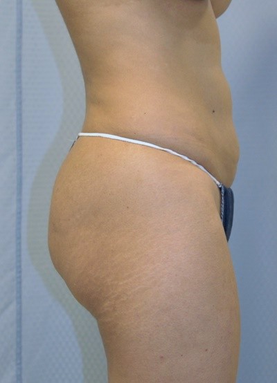 brazilian-butt-lift-plastic-surgery-beverly-hills-los-angeles-woman-before-side-dr-maan-kattash