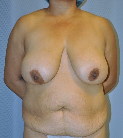 breast-lift-reduction-plastic-surgery-rancho-cucamonga-woman-front-before-surgeon-dr-maan-kattash