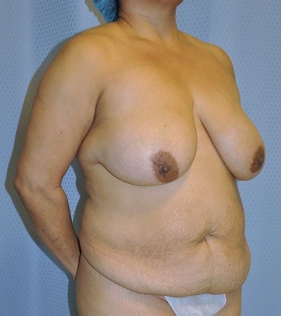 breast-lift-reduction-plastic-surgery-rancho-cucamonga-woman-oblique-before-surgeon-dr-maan-kattash