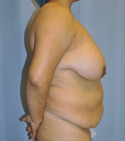 breast-lift-reduction-plastic-surgery-rancho-cucamonga-woman-side-before-surgeon-dr-maan-kattash