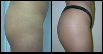 Buttock Augmentation before and after pictures.