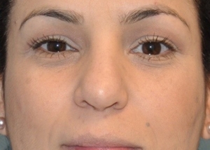 rhinoplasty-plastic-surgery-nose-job-beverly-hills-woman-after-front-dr-maan-kattash