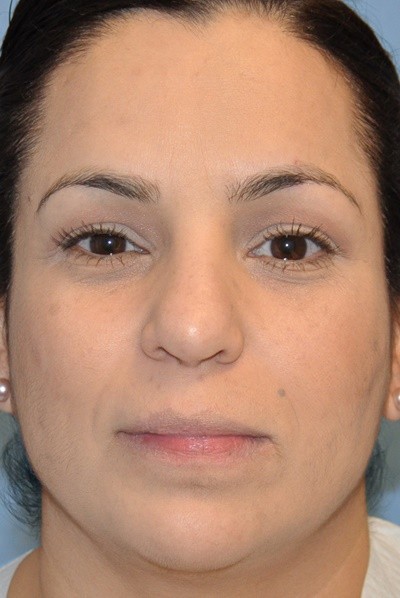 rhinoplasty-plastic-surgery-nose-job-beverly-hills-woman-after-front-dr-maan-kattash